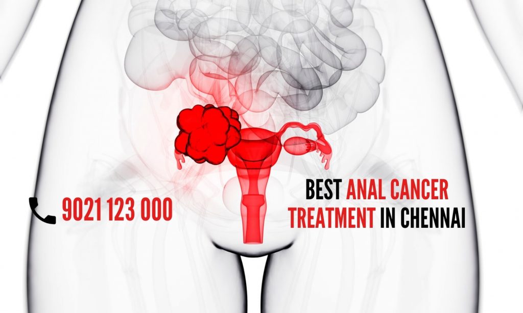 What is Anal Cancer 5 Early Anal Cancer Symptoms