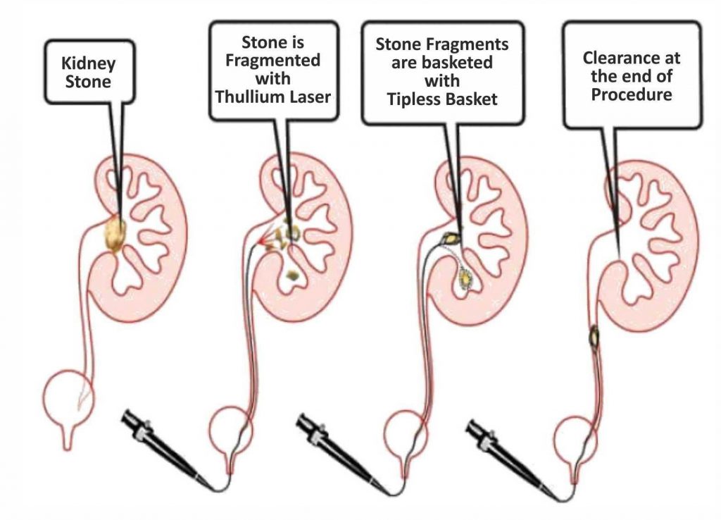 How to prevent Kidney Stones by Dr Griffin M (3)