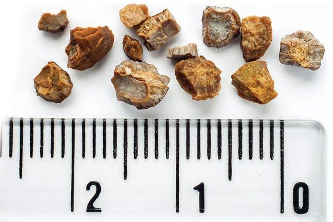 How to prevent Kidney Stones by Dr Griffin M (3)