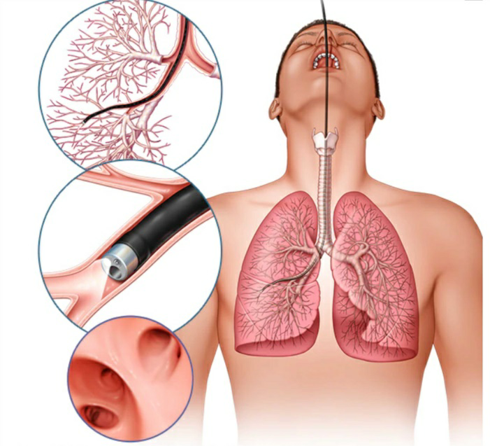 Lung Cancer has an 88% Survival Rate when caught Early and Treated 23