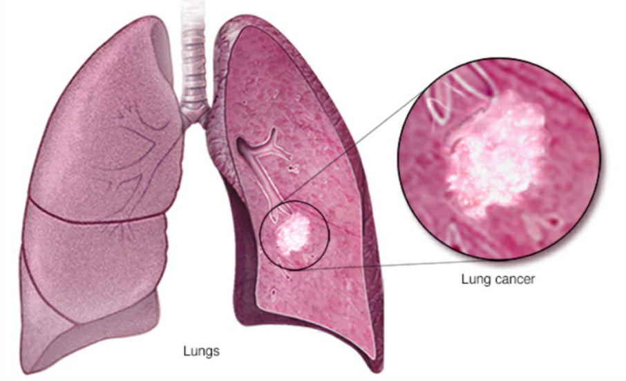 Lung Cancer has an 88% Survival Rate when caught Early and Treated