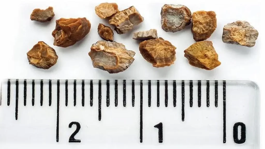 How to prevent Kidney Stones by Dr Griffin