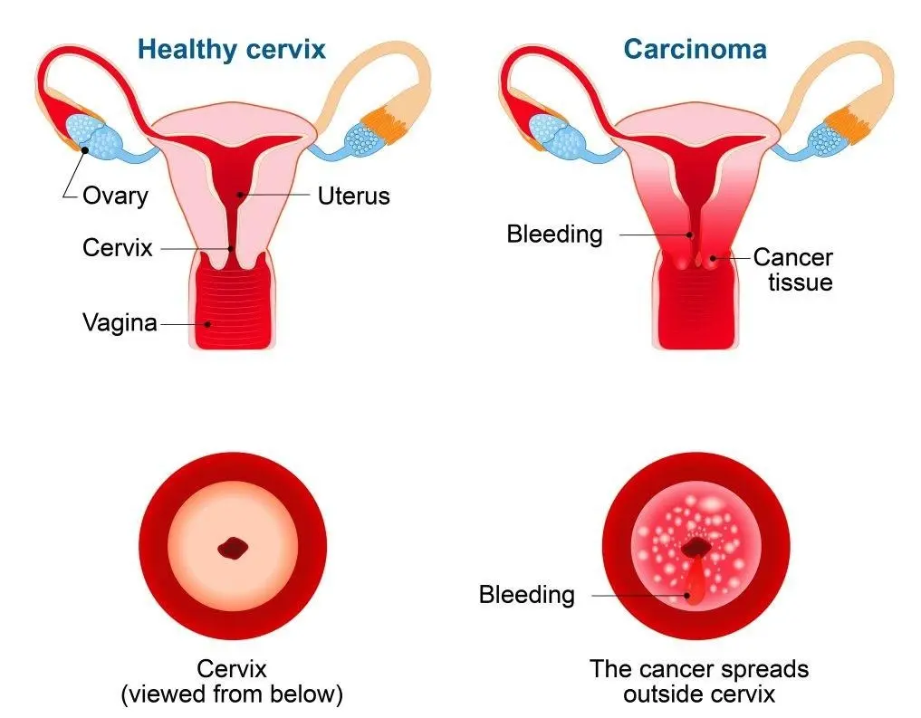 Cervical cancer prevention, Causes, Symptoms 3