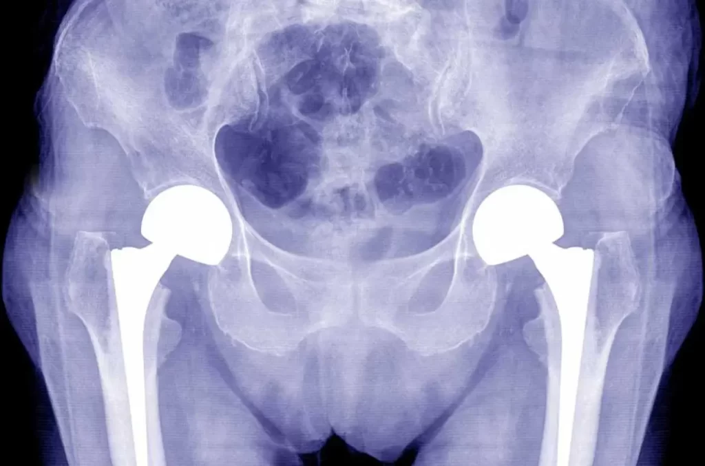 Best Total Hip Replacement Surgery Hospital in Chennai - Orthopedics - THR OVERVIEW