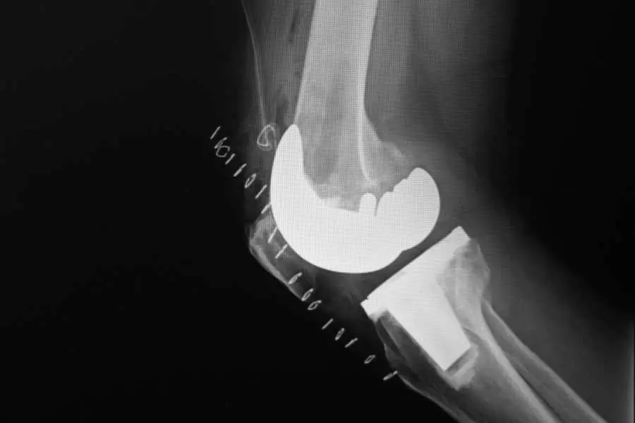 Orthopedics - Best Unilateral Knee Replacement Surgery in Chennai - Video 2 (1)