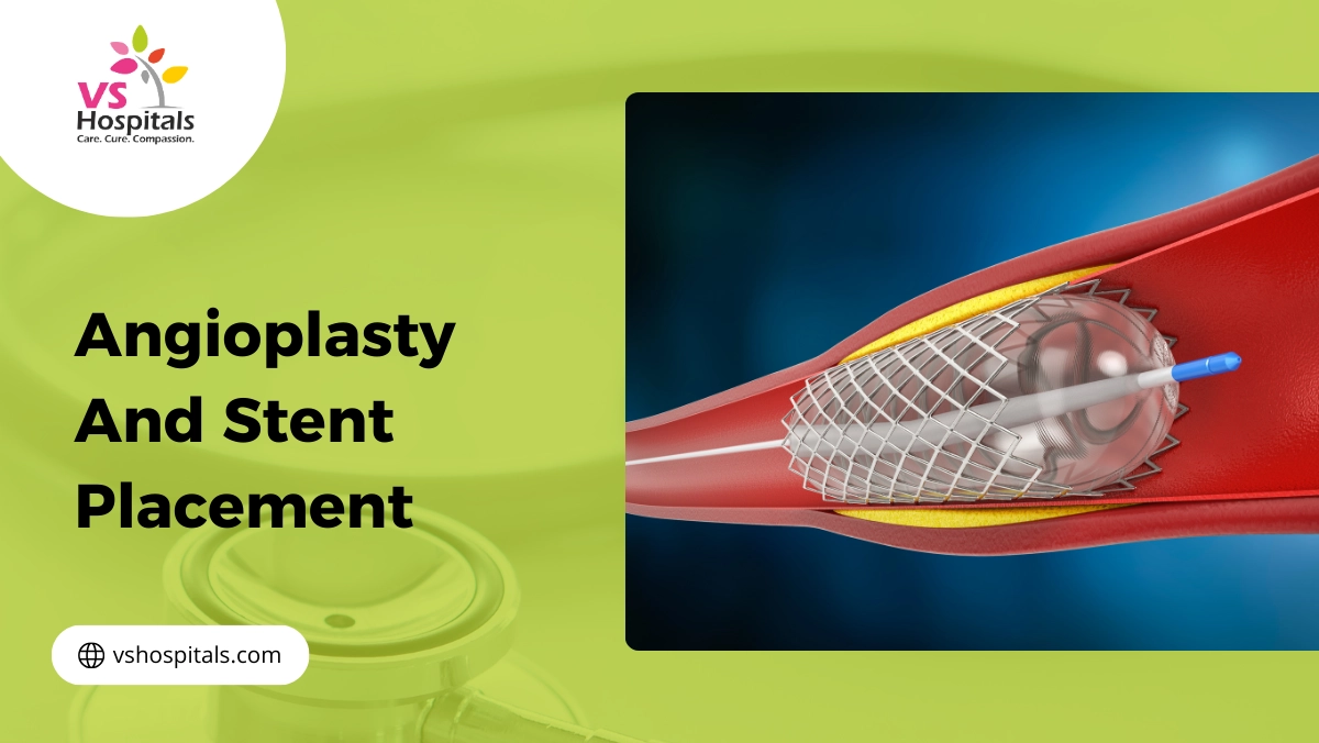 Angioplasty And Stent Placement