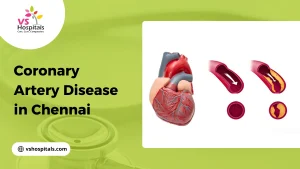 Coronary Artery Disease in Chennai